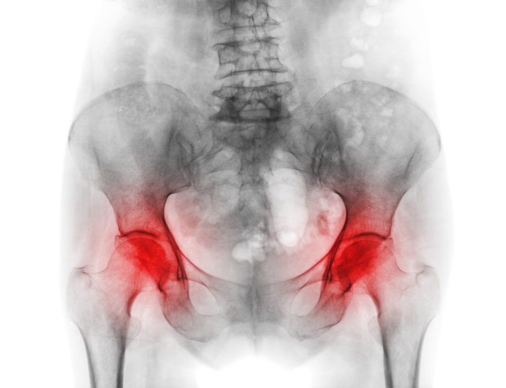 localizzazione comune del dolore d'anca