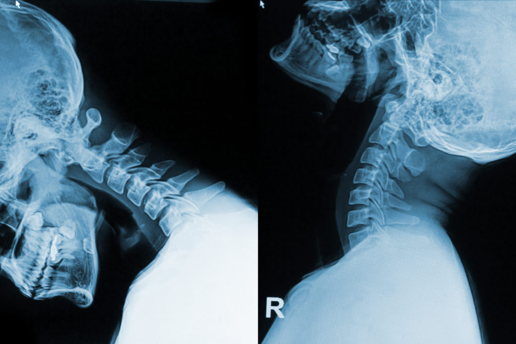 Radiografie per sintomi da cervicale